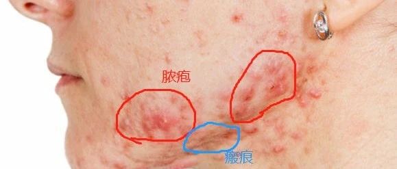 腮边起痘？淋巴来救！